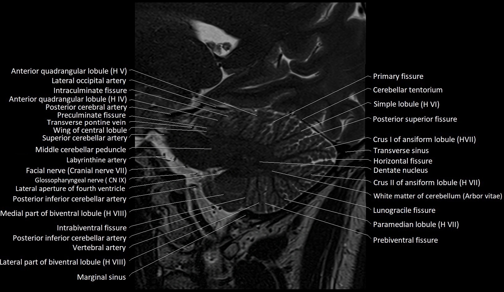 MRI Cerebellar anatomy sagittal High-resolution labelled image 22.webp